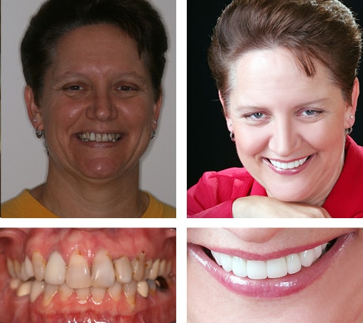 Dental Smile Gallery Case Showing A Real Patient's Smile Transformation 