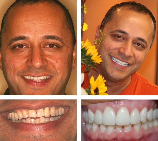 Dental Smile Gallery Case Showing A Real Patient's Smile Transformation 